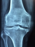 Osteoporoza - jakie są jej przyczyny